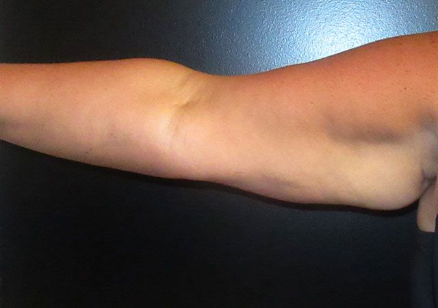 Coolsculpting Before & After