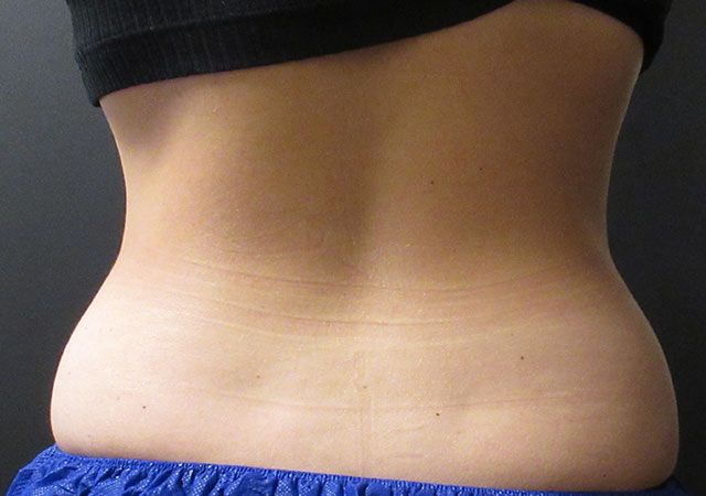 Coolsculpting Before & After