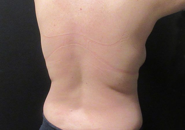 Coolsculpting Before & After