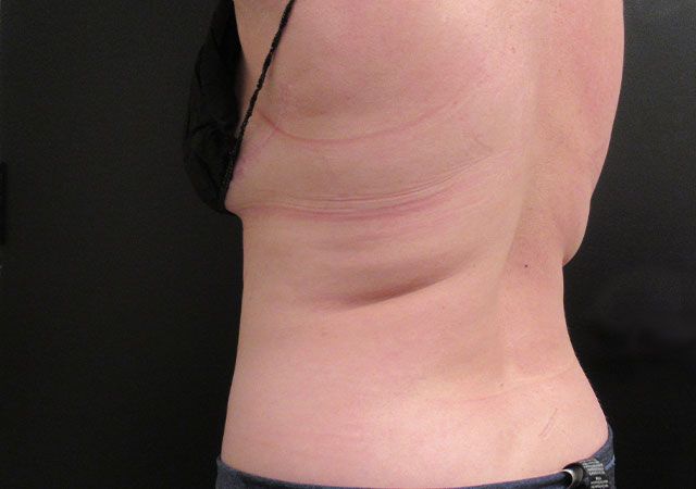 Coolsculpting Before & After