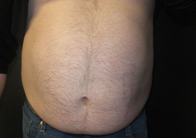 Coolsculpting Before & After