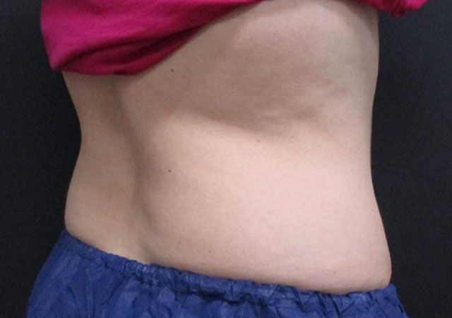 Coolsculpting Before & After