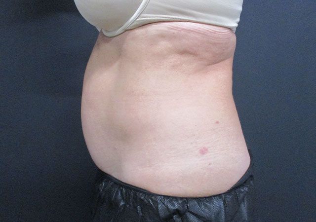 Coolsculpting Before & After