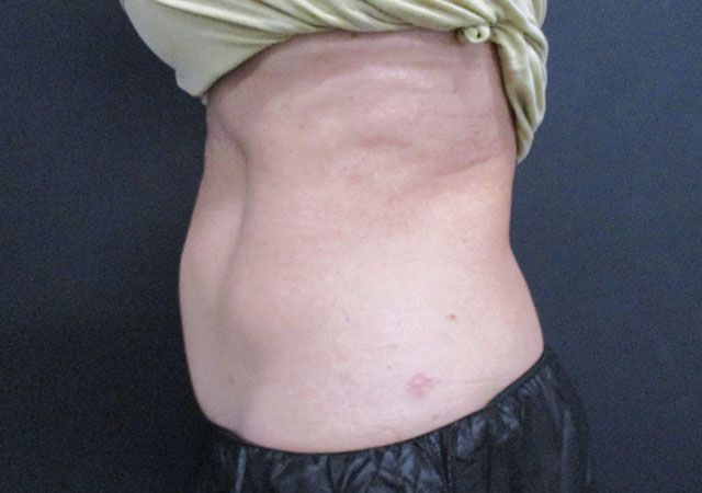 Coolsculpting Before & After