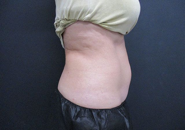 Coolsculpting Before & After