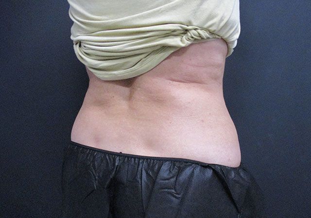 Coolsculpting Before & After