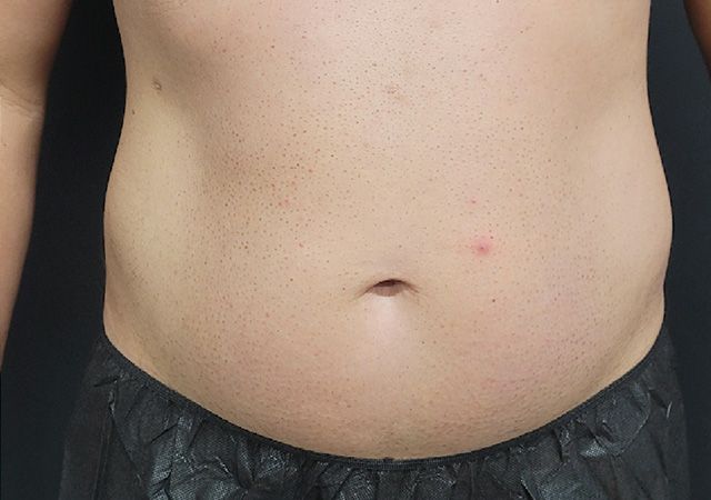 Coolsculpting Before & After