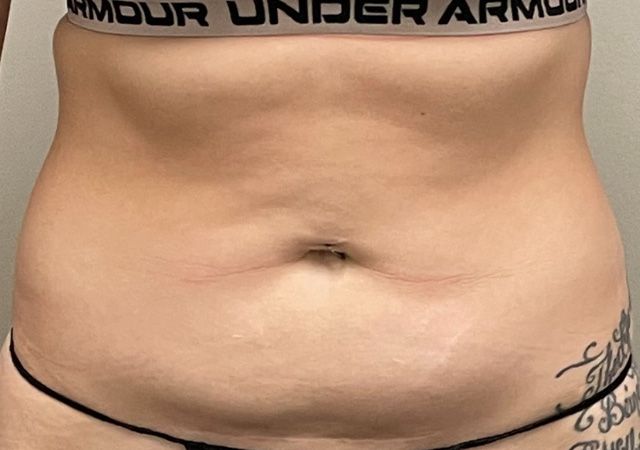 Coolsculpting Before & After