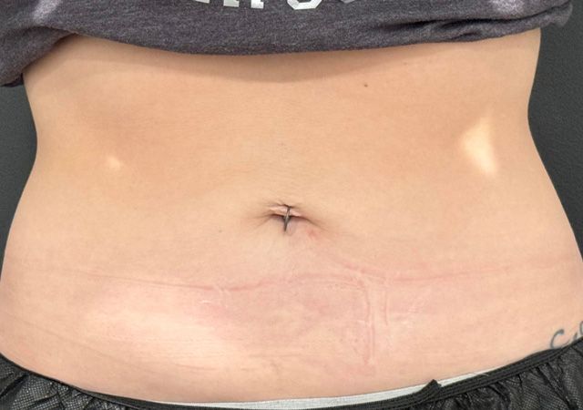 Coolsculpting Before & After