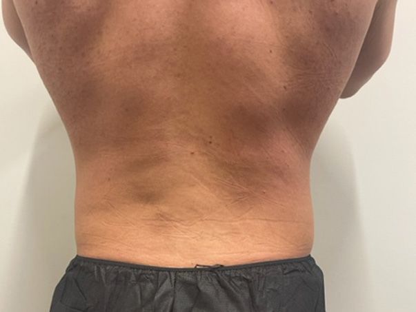 Coolsculpting Before & After