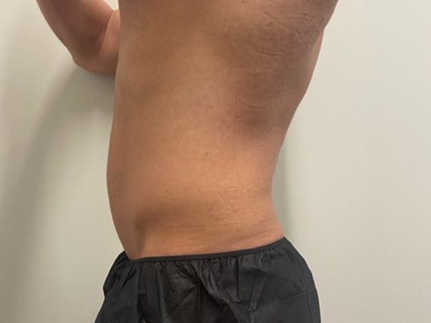 Coolsculpting Before & After