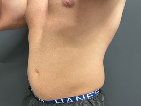 Coolsculpting Before & After