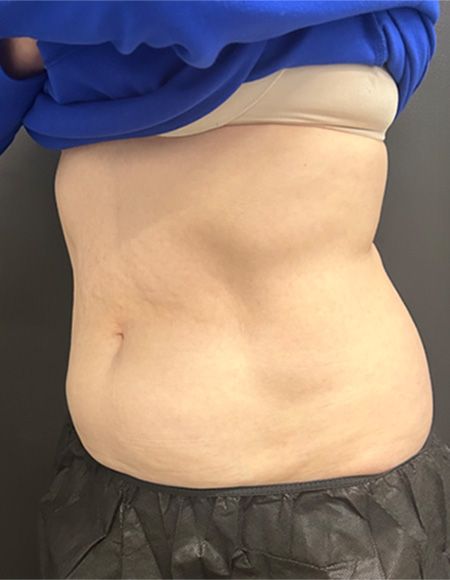 CoolSculpting Before & After