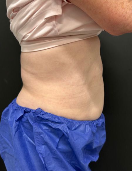 CoolSculpting Before & After