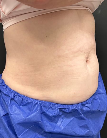 CoolSculpting Before & After