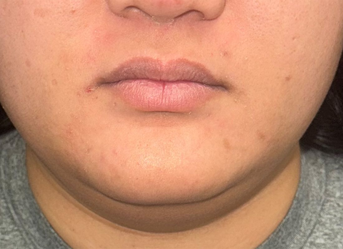 CoolSculpting Before & After