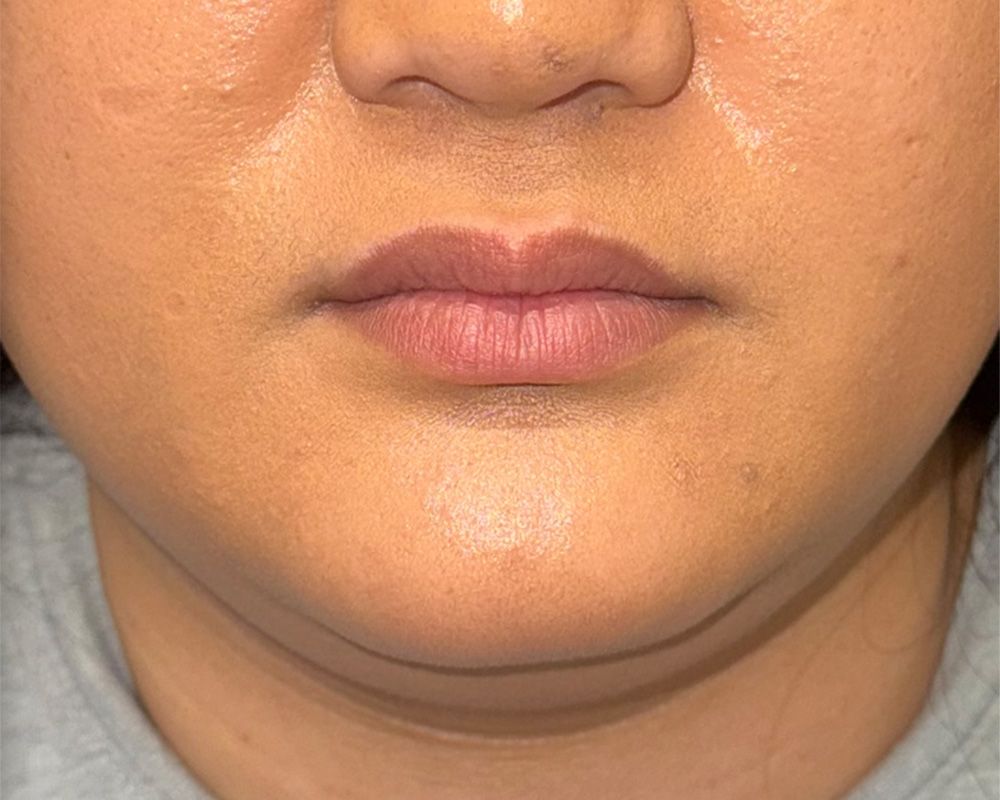 CoolSculpting Before & After