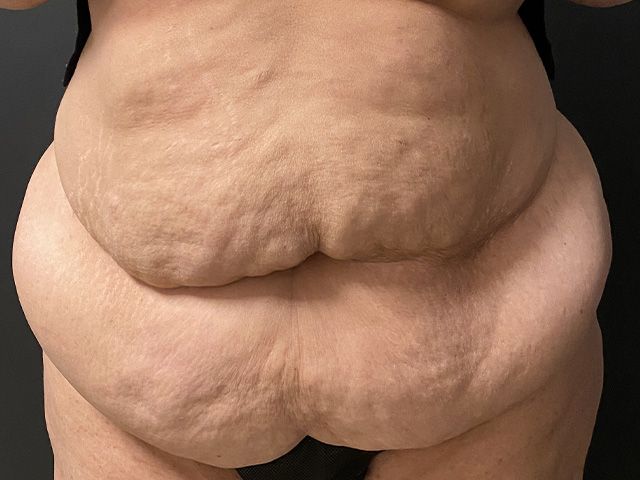 Elite Tummy Tuck Before & After