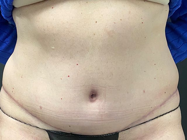 Elite Tummy Tuck Before & After