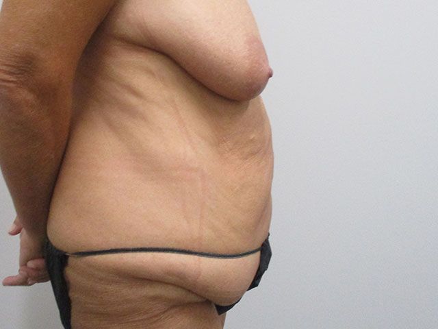 Elite Tummy Tuck Before & After