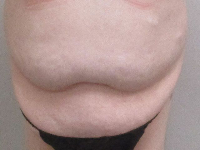 Elite Tummy Tuck Before & After