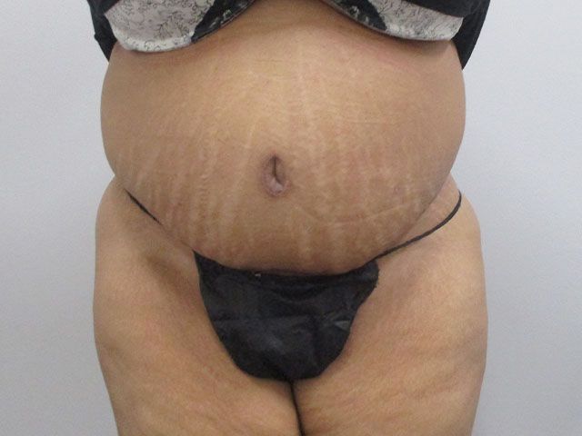 Elite Tummy Tuck Before & After