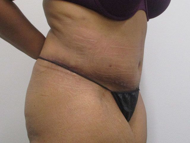 Elite Tummy Tuck Before & After