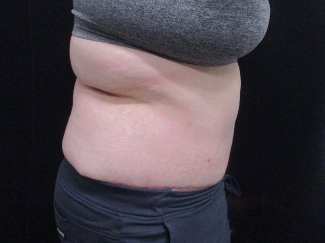 Elite Tummy Tuck Before & After