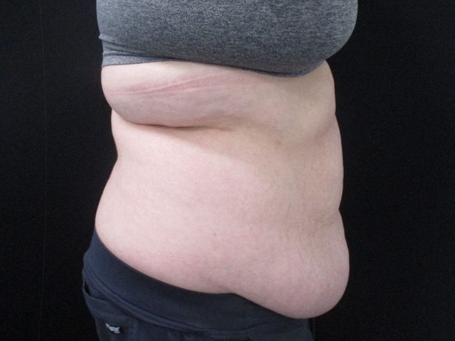 Elite Tummy Tuck Before & After