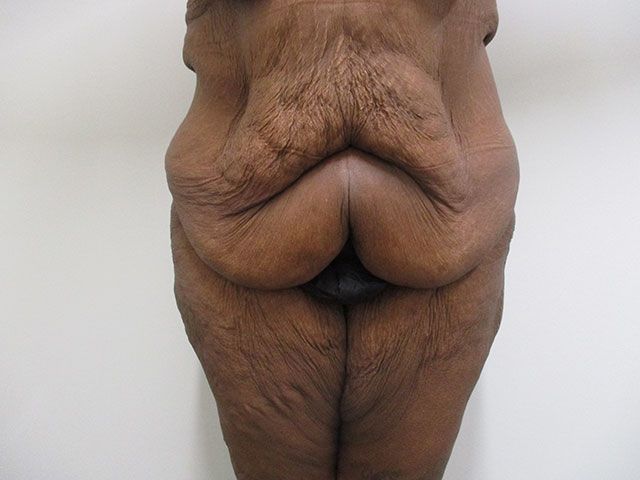 Elite Tummy Tuck Before & After