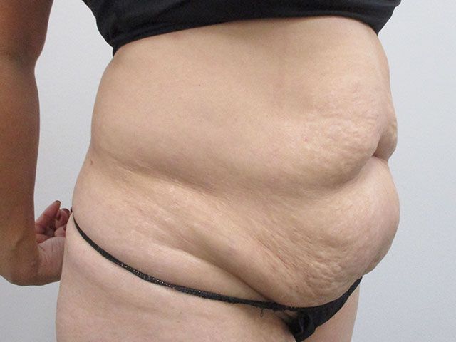 Elite Tummy Tuck Before & After