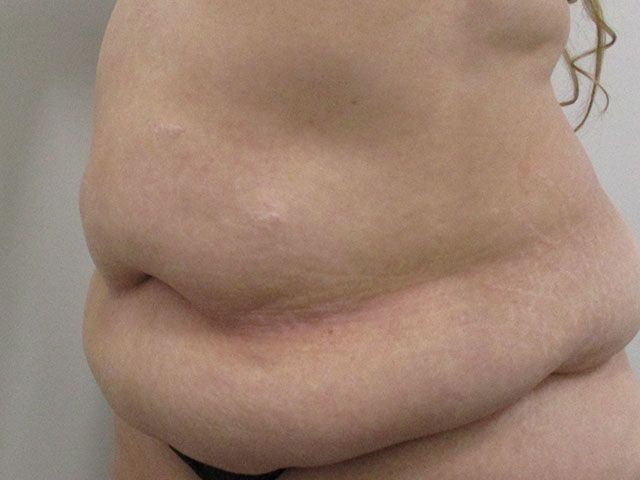 Elite Tummy Tuck Before & After