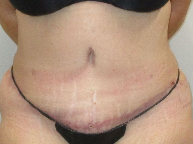 Elite Tummy Tuck Before & After