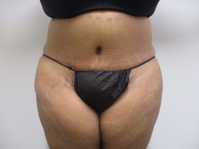 Elite Tummy Tuck Before & After