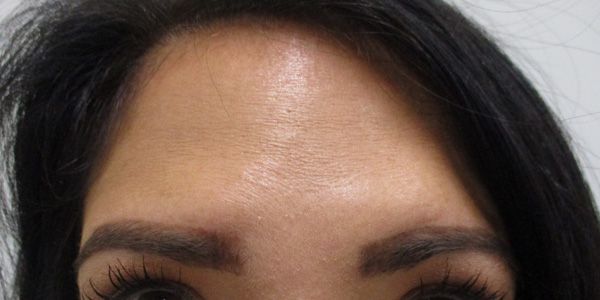 Botox Before & After