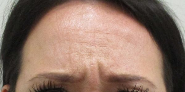Botox Before & After