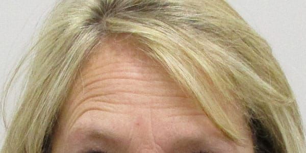 Botox Before & After