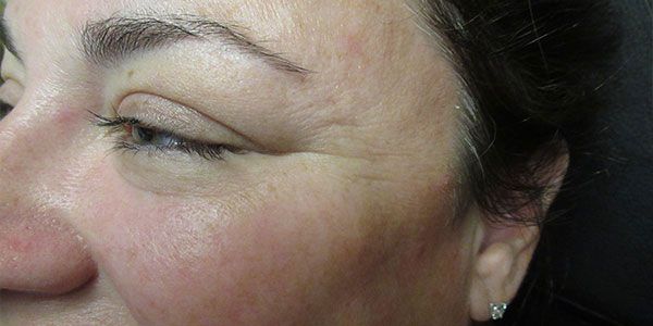 Botox Before & After