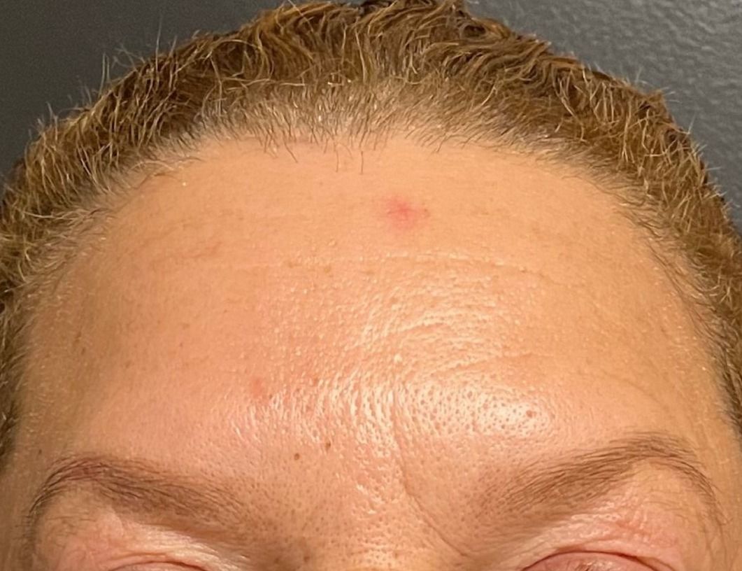 Botox Before & After