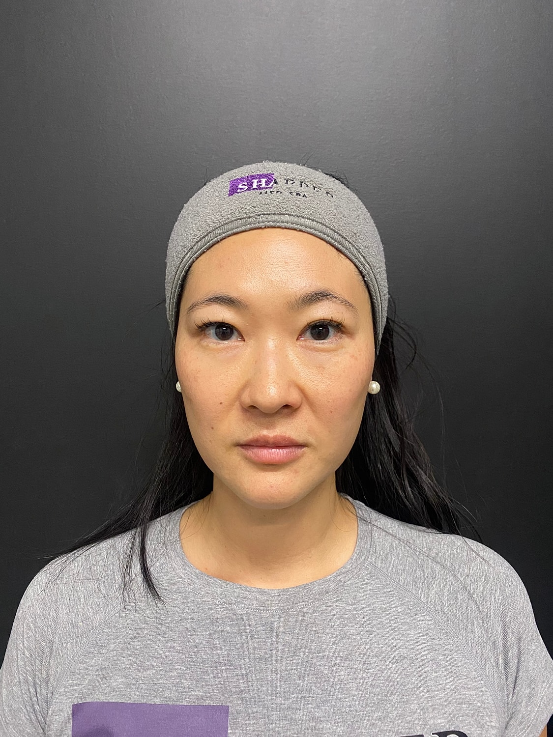 Botox Before & After