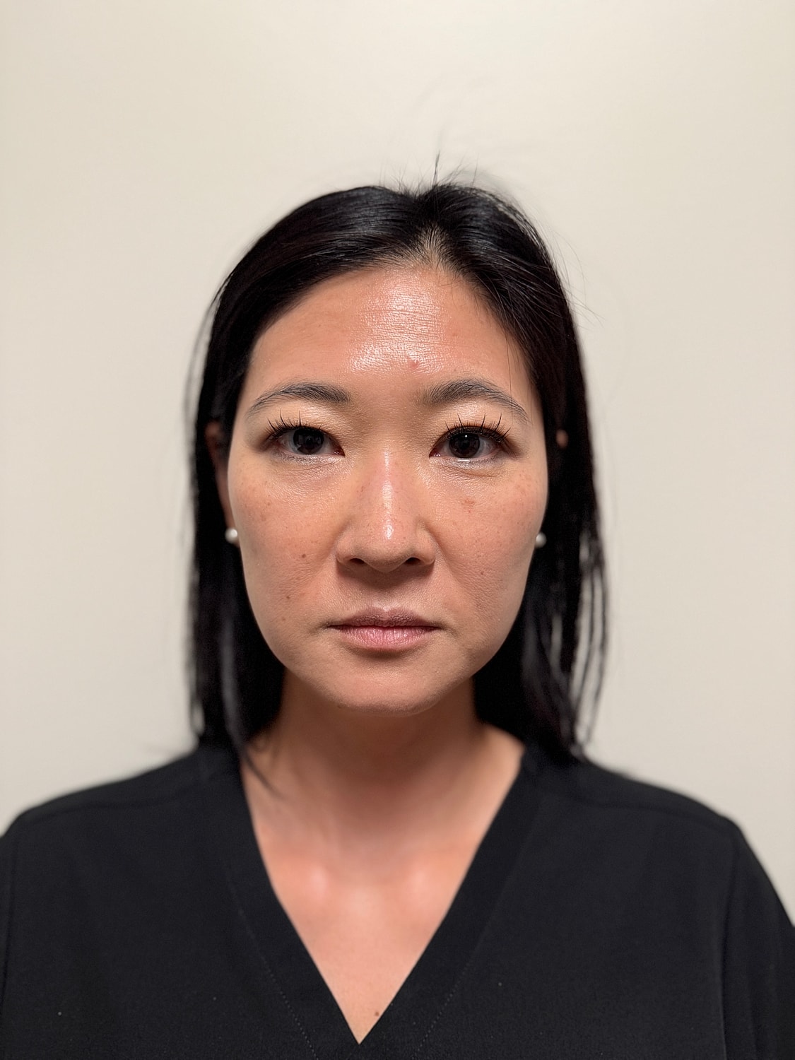 Botox Before & After