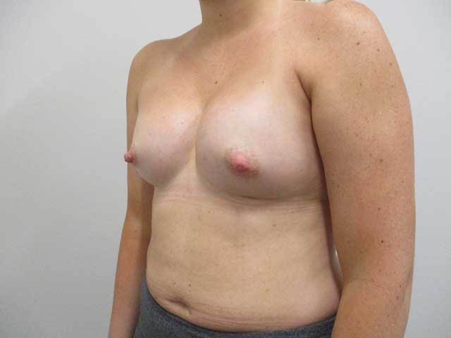 Breast Augmentation Before & After