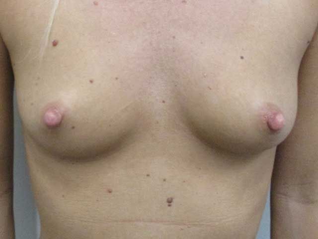 Breast Augmentation Before & After