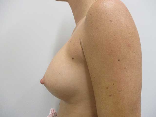 Breast Augmentation Before & After