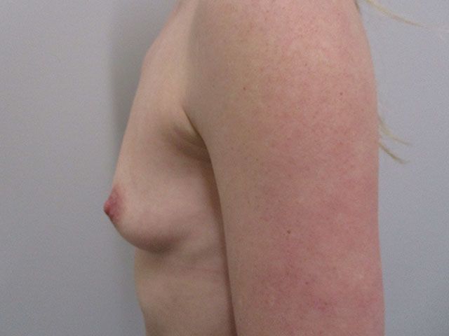 Breast Augmentation Before & After