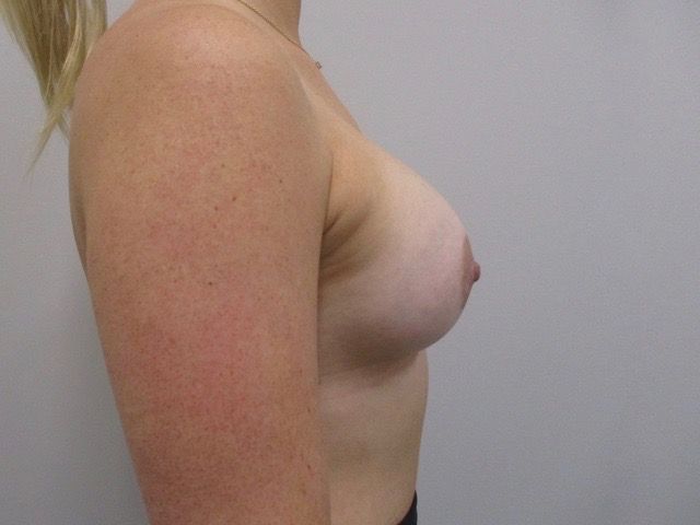 Breast Augmentation Before & After