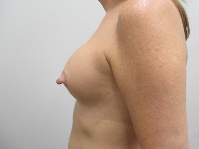 Breast Augmentation Before & After