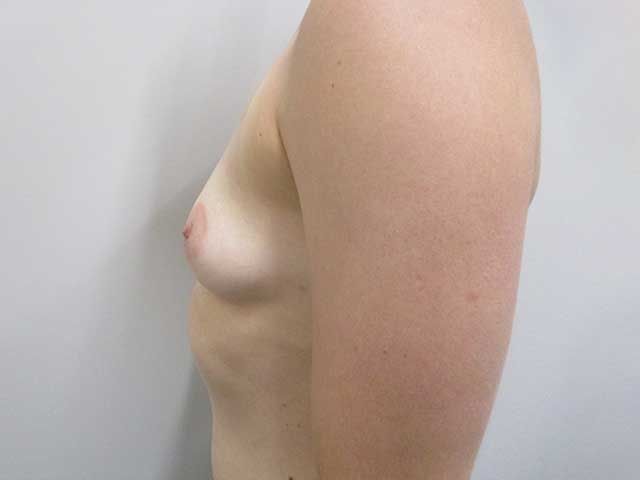 Breast Augmentation Before & After