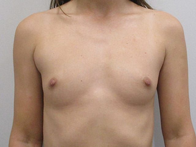 Breast Augmentation Before & After
