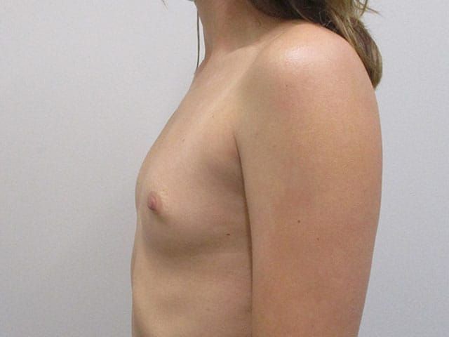 Breast Augmentation Before & After